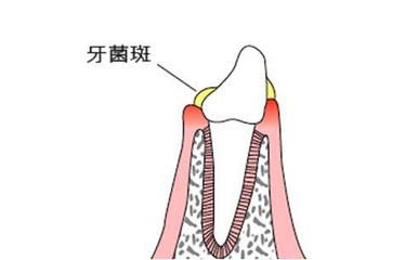 短科普丨牙结石是如何形成的