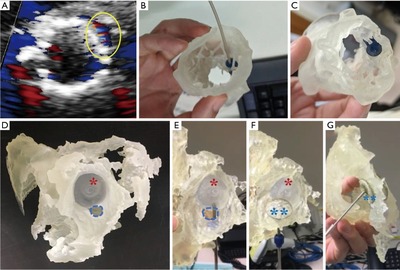香港中文大学研究有关心脏病的3D打印