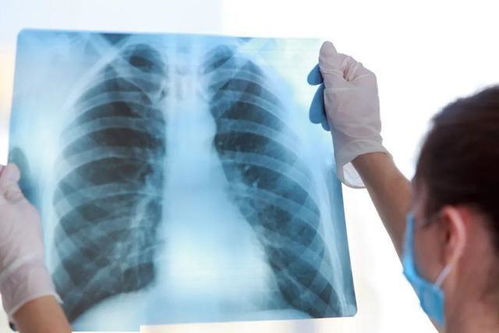 体检报告中显示的肺结节 甲状腺结节 钙化是什么意思 教你读懂
