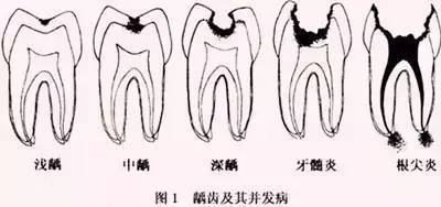 你的牙齿是如何像你的女朋友一样离开你的