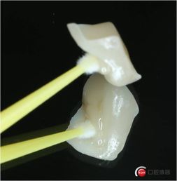 一例钙化根管的治疗